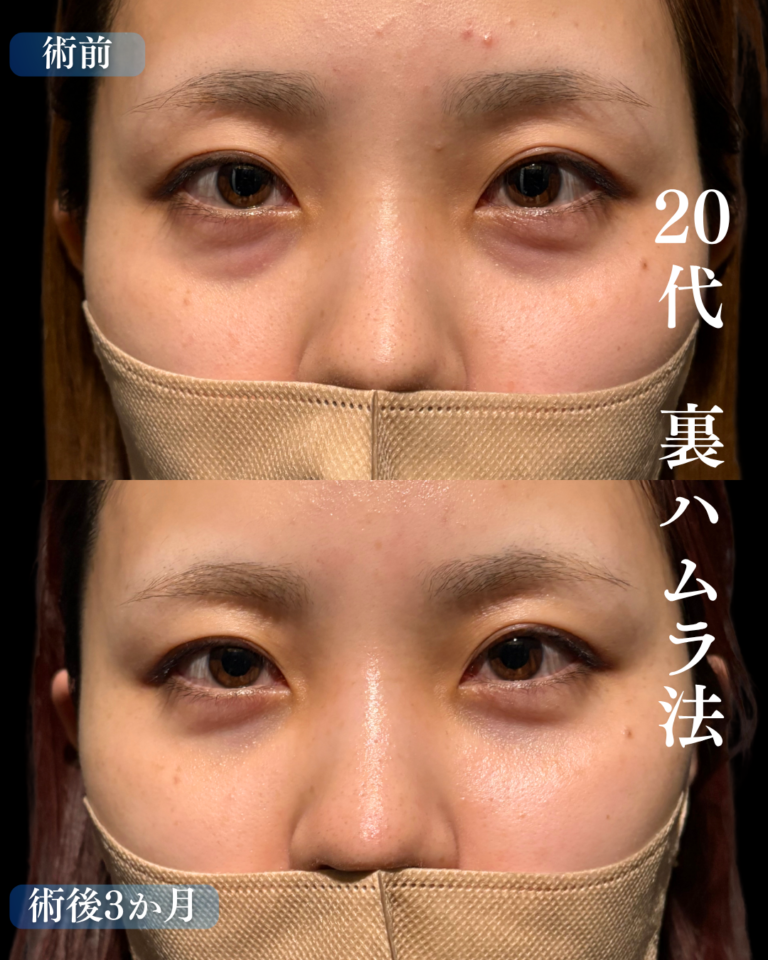 20代女性　裏ハムラ法